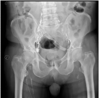 Fig. 1. Lymphangiography showing no contrast spreading.