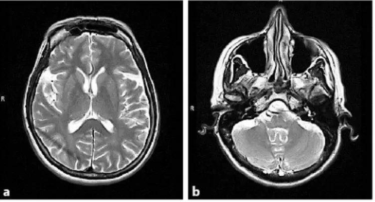 Fig. 1.  MRI of the brain. No significant cortical (a) or cerebellar atrophy (b) is present