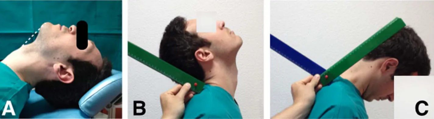 Fig. 1. Measurement of thyro-mental distance along a straight line from the thyroid notch to the lower border of the mandibular symphysis with the head fully extended (A); measurement of the degree of neck flexion-extension by asking the patient to extend 