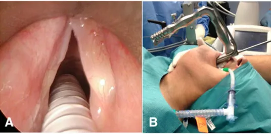 Fig. 4. Class II, or the anterior com- com-missure visualization, through a large-bore laryngoscope (A) with external laryngeal counterpressure in the flexion-flexion position (B)