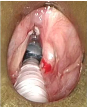 Fig. 5. Class III, or the anterior commissure visualization, through a small-bore laryngoscope with external laryngeal counterpressure in the flexion-flexion position