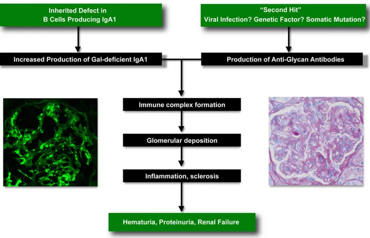 Fig. 3 The model of immunoglobulin A nephropathy (IgAN) pathogenesis in patients with high levels of galactose-deficient IgA1