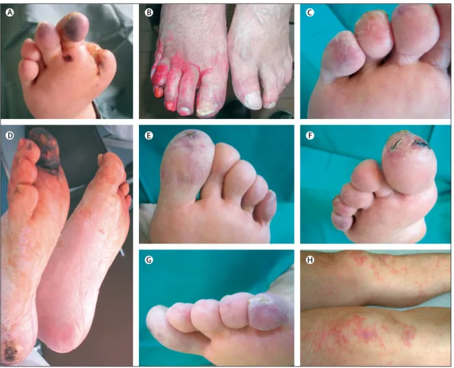 Figure 3: Skin lesions in atheroembolic renal disease