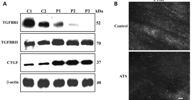 Figure 5. TGFBRI, TGFBRII and CTGF expression in ATS ﬁbroblasts. (A) WB of 50 µg cell membrane-bound proteins extracted from control (C1 and C2) and ATS (P1, P2 and P3) ﬁbroblasts immunoreacted with the anti-human TGFBRI and TGFBRII Abs, detecting a 52 and