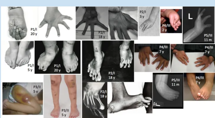 FIG. 2. Characteristic findings of hands and feet of MC-EDS patients, and an example of hematoma-formation
