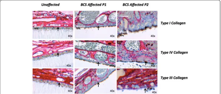 Fig. 4 Changes in extracellular matrix collagens in Bruch ’s membrane in PRDM5-associated disease