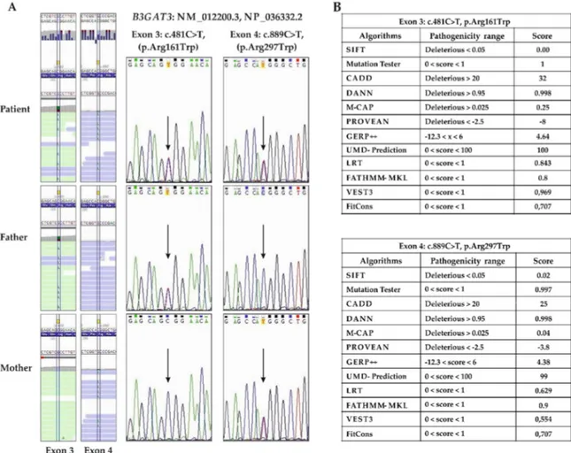 Figure 3. Molecular findings. (A) ES data alignments show the compound heterozygosity of the  paternal c.481C&gt;T (p.Arg161Trp) and the maternal c.889C&gt;T (p.Arg297Trp) missense variants