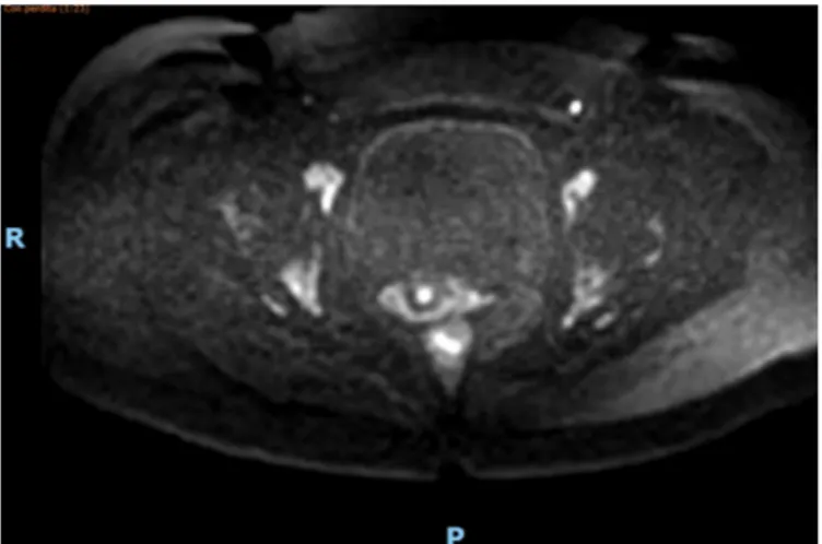 Figure 1. DW-MRI. Signal present in the anterior bladder wall in IC patient. (Color version available online.)