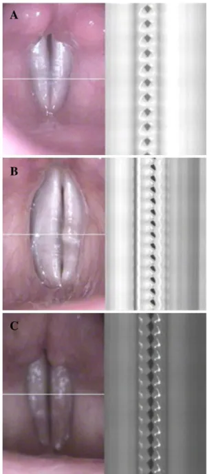 Fig. 2 Schematic drawing of a kymogram showing the  ampli-tude of vibration of both vocal folds and related R amp 