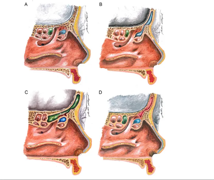 FIGURE 1. The Terracol and Ardouin model of frontal sinus development. (A) Postnatal anatomy of the frontoethmoidal area: the bullar cell lies at the top of the bullar complex, the nasal cell is enclosed between the vertical portion of the uncinate process