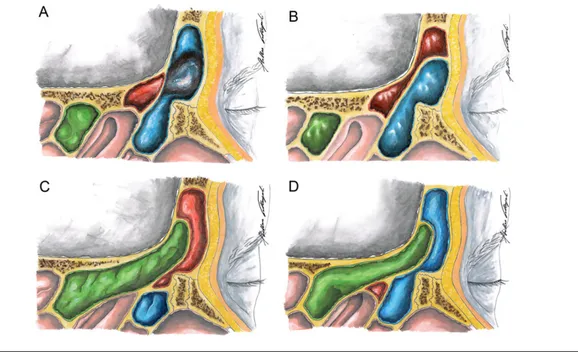 FIGURE 4. Development of frontoethmoidal cells. (A) The supra-agger frontal cell takes form when the frontal sinus arises from the nasal cell and an orbital cell grows toward the frontal bone, thus pushing/dislocating the drainage pathway posteromedially