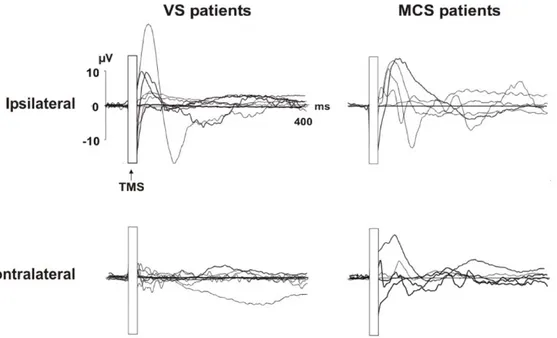 Figure 2. Individual TEPs recorded from both hemispheres for the two groups of patients: VS patients are shown in the left column, and MCS patients are shown in the right column