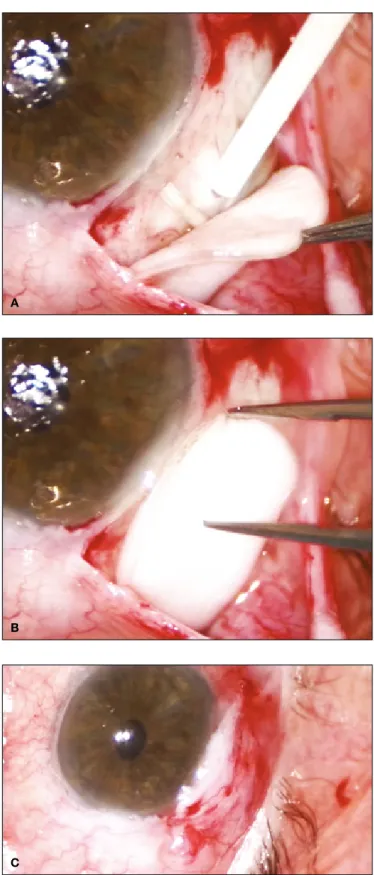 Fig. 1 -  (A)  The patch graft is positioned just anterior to the tube 