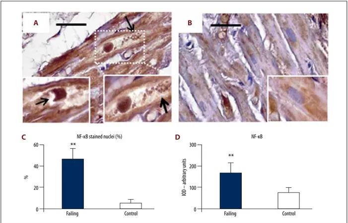 Figure 8.    NF-kB immunostaining. ( A ) Cardiomyocytes in failing heart had intense NF-kB staining distributed not only inside large  cytoplasm areas, but also in a large proportion of nuclei