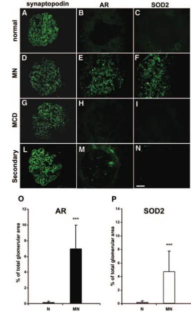 Figure 3. AR and SOD2 are expressed in renal biopsies of MN patients. (A through N) Representative images of renal biopsy specimens from normal patients (A through C), and patients with MN (D through F), MCD (G through I), and MN secondary to neoplasia (L 