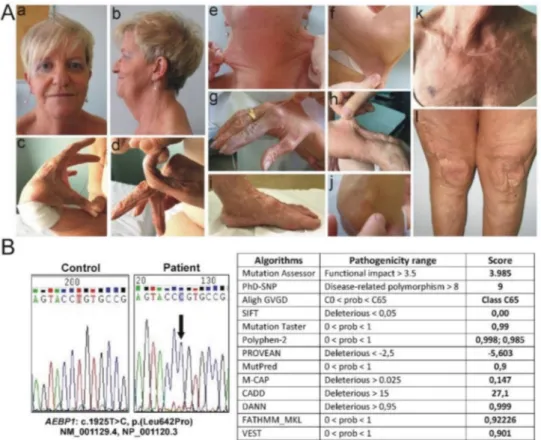 Figure 1. Clinical and molecular findings of the patient. (A) Old-aging appearance of face and androgenetic alopecia (a,b); laxity of the thumb (c), laxity of the fifth finger (d); hyperextensible skin in different body areas: neck (e), elbow (f), dorsum o