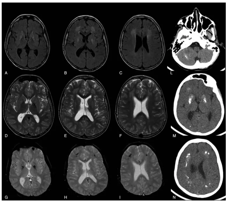 Figure 3. Neuroradiological ﬁndings (brain MRI and CT) of patient No. 1 at the age of thirteen years showing a mild progression of the periventricular white matter lesions (above all in the frontal area) and diffuse calci ﬁcations