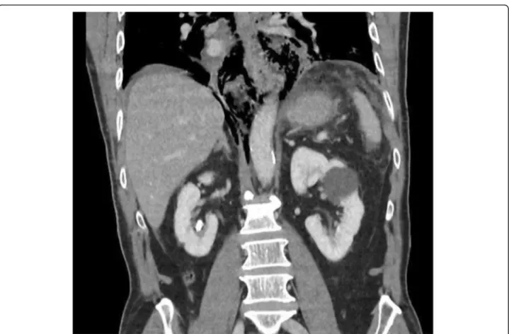 Fig. 4 Coronal CT showing mediastinal air but minimal pleural reaction in a patient with spontaneous EP (Boerhaaves)