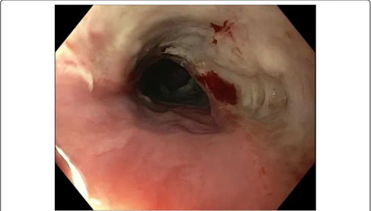 Fig. 1 Endoscopic view of esophageal injury from button battery ingestion (at 6 h) in a 5-year old with intellectual disability