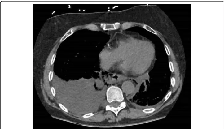 Fig. 3 Axial CT showing a right pleural effusion, mediastinal air and esophageal wall disruption in a patient with spontaneous EP (Boerhaaves)