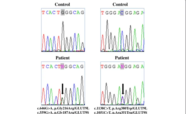 Figure 1 Molecular characterization of the patient. Left panel: Sequence chromatogram showing the position of the heterozygous c.646G&gt;A transition (NM_020041.2, GLUT9L, exon 7) corresponding to c.559G&gt;A (NM_00100290.1, GLUT9S, exon 7), leading to the