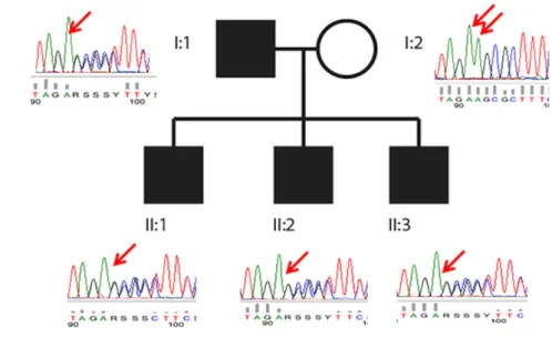Figure 1. LMAN2L c.1073delT mutation is associated with an autosomal dominant neurological syndrome