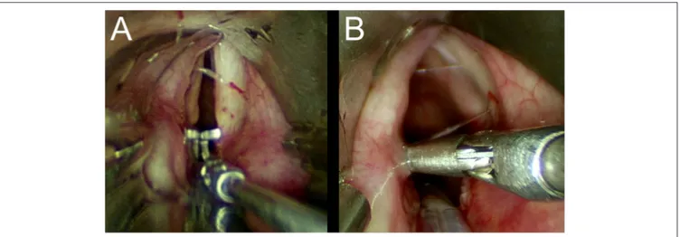 FIGURE 7 | (A,B) Lindholm cord retractor.