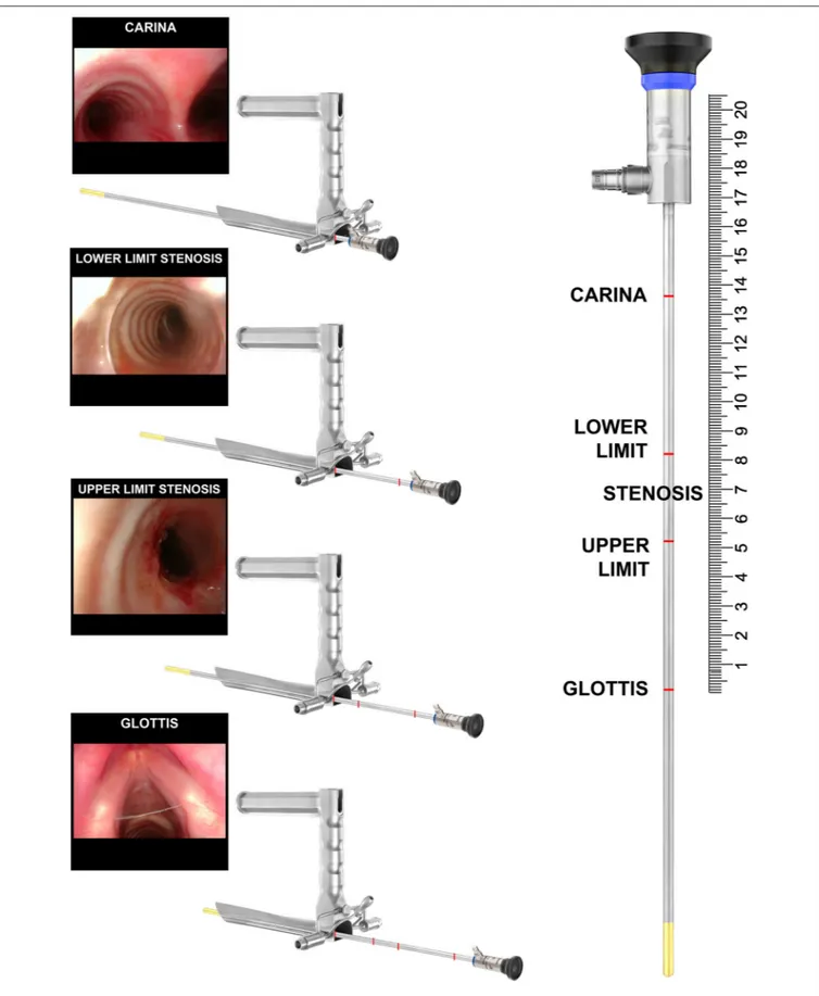 FIGURE 6 | Intraoperative measurement of a 3 cm tract of the tracheal stenosis during suspension microlaryngoscopy.