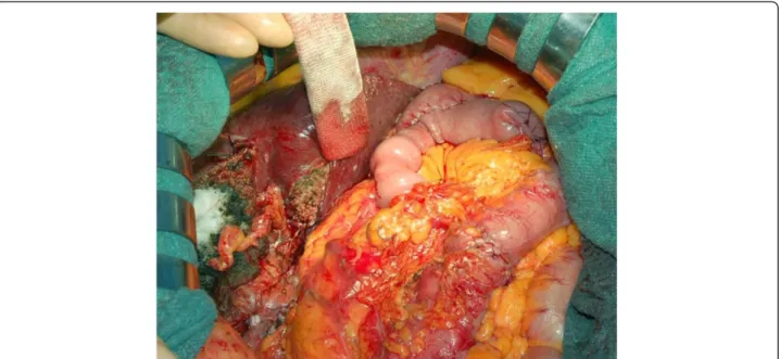 Figure 2 Intraoperative view . Intraoperative view at the end of the multivisceral resection and reconstruction.