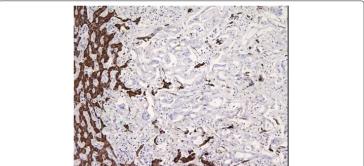Figure 4 Liver specimen pathology. Final pathology on liver cancer specimen. The anti-hepatocyte monoclonal antibodies were negative.