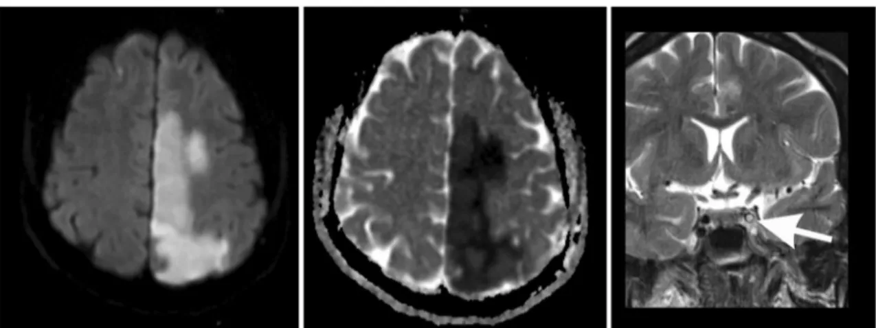 Fig. 1 Acute left frontal–parietal ischemic lesion on diffusion- diffusion-weighted image (left) and apparent diffusion coefficient (center) on magnetic resonance imaging of the brain
