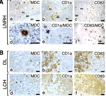 Fig. 6. Expression of MDC in human lymph node reactive hyperplasia (LNRH), dermopathic lymphadenopathy (DL), and Langer-