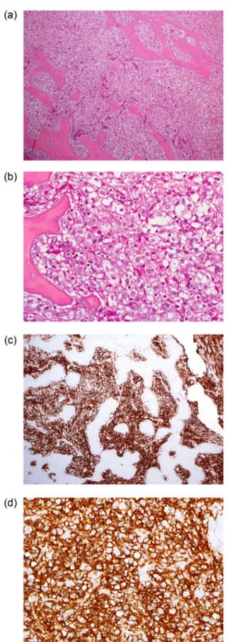 Fig. 5 – Low (a, c) and high (b, d) power view of bone biopsy stained with hematoxylin-eosin (a-b) and anti-CD20 (c-d)