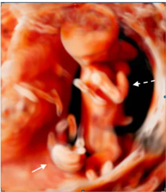 Figure 2 Color Doppler image of an acardiac twin at 14 weeks showing reverse perfusion through the umbilical cord.