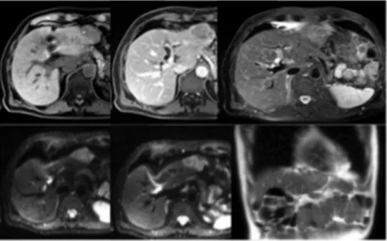 Fig. 1. RMN imaging: typical radiological aspect of a liver metastasis. No other localizations are evident in the RMN.