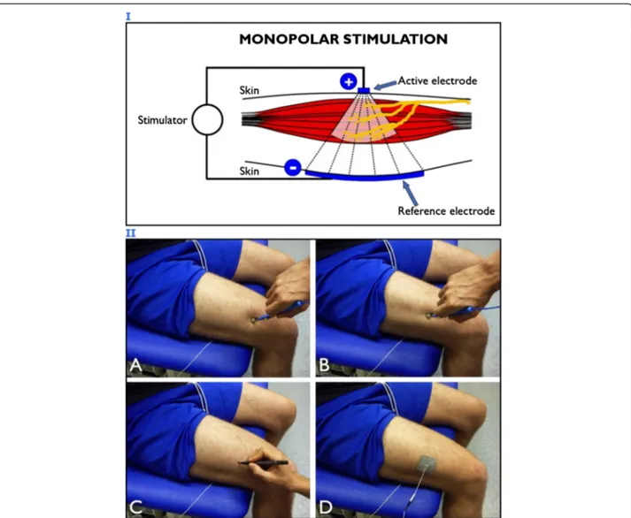 Figure 4 Motor point identification procedure. Panel I: schematic representation of monopolar stimulation