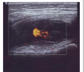 Figure 1 Case 1 left knee ultrasound. Transverse gray-scale and color Doppler 12 –5 MHz ultrasound image obtained over the medial aspect of the knee showing abundant synovial pannus filling the subquadriceps recess as a band of hypoechoic tissue intermingl