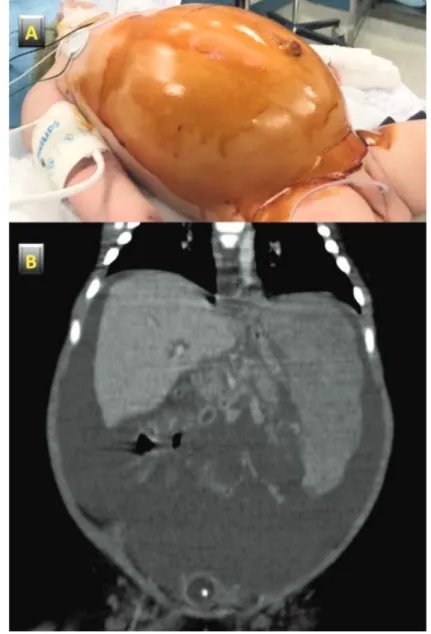 Figure 1. Clinical and imaging features. A) severe abdominal distension at admission; B) large isodense splenic mass and abdominal hemorrhage at computed tomography.