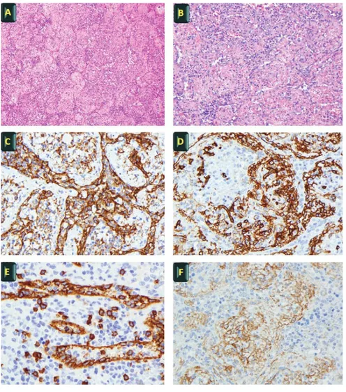 Figure 2. Histological evaluation. A-B) H&amp;E - typical vascular appearance of SANT (x20, Panel A; and x40, Panel B); C-D) Diffuse positivity of vascular channels for CD 31 (x40, Panel C) and CD34 (x40, Panel D); E-F) Vascular channels positive for CD8 (