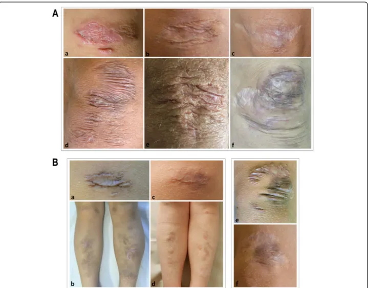 Fig. 1 A) Representative images of different atrophic scars on cEDS patients ’ knees. A healing scar in a 6-year-old girl (a); a papyraceous, non- non-hemosiderotic scar in a 22-year-old female (b); a cigarette paper scar in a 39-year-old female (c); multi