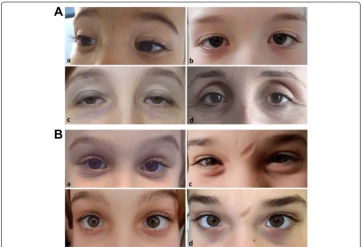 Fig. 2 A) Representative images of characteristic ocular features in cEDS patients from different ages