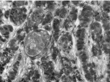 Fig. 1. Photomicrograph of the biopsy specimen (haematoxylin/eosin stain- stain-ing), showing basaloid cells and focal areas of squamous differentiation with  keratinization.