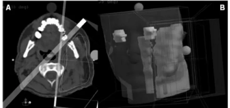 Fig. 5. Post-operative result 18 months after palliative treatment. Fig. 4. A: Planning CT scan, transversal dose distribution for  three-dimen-sional conformal radiation therapy, three wedged fields