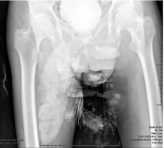 Fig. 2. Urethra-cystography shows bladder-neck leakage and a fluid collection from the pelvis to the right inner thigh