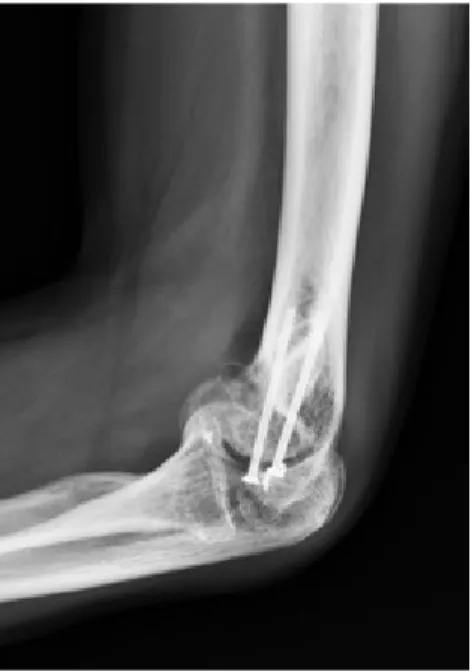 Figure 4. Functional re-education to pronation-supination.Figure 2. X-ray views (AP) showing 
