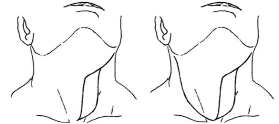 Fig. 3 . When the dissection reaches the upper pole of the thyroid gland, the crico-thyroid artery (at the midline of the neck) and the posterior branch of the superior thyroid artery (at its entrance in the upper pole of the gland) are cut, ligated and ke