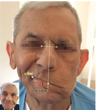 Figure 1. Preoperative 80-year-old smiling patient with SMILE measurements: the z-line represents the commissure excursion, and the a-value represents the smile angle