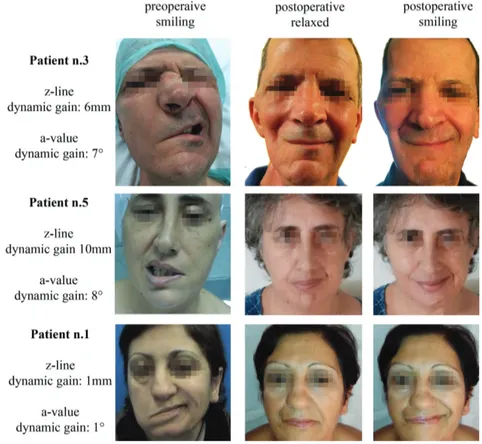 Figure 2. Preoperative smiling views and postoperative static and dynamic results.