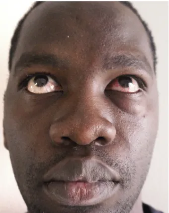 Fig. 6. Preoperative photograph of patient A. Left enophthalmos and left eye chemosis are clearly visible.