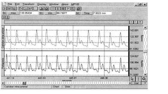 Figure 1 Example of intra-arterial (upper) and finger (lower) pulse pressure profiles recorded at rest